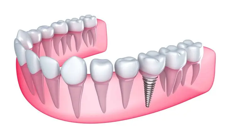 Teeth Implants