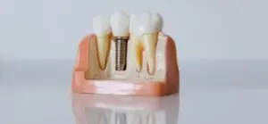 How to fix your missing teeth with dental implants