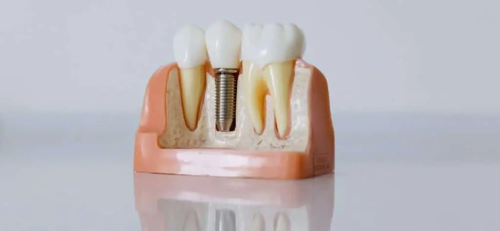 fix your missing teeth with dental implants image