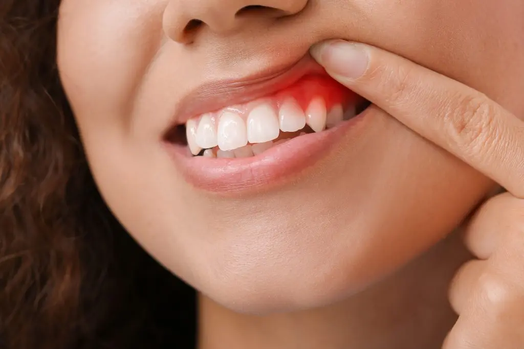 gum disease image