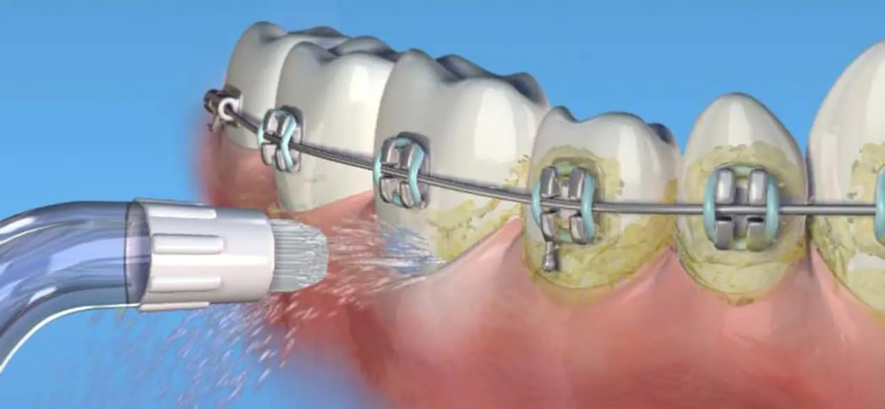 Are Water Picks Good For Your Teeth image