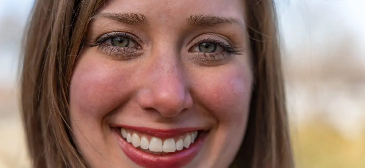 dental veneers alternative to orthodontics image