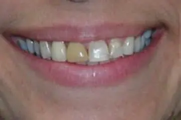 an image of a woman with mole smiling before her procedure in big smile dental