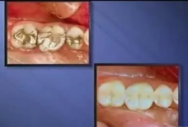 video placeholder tooth colored