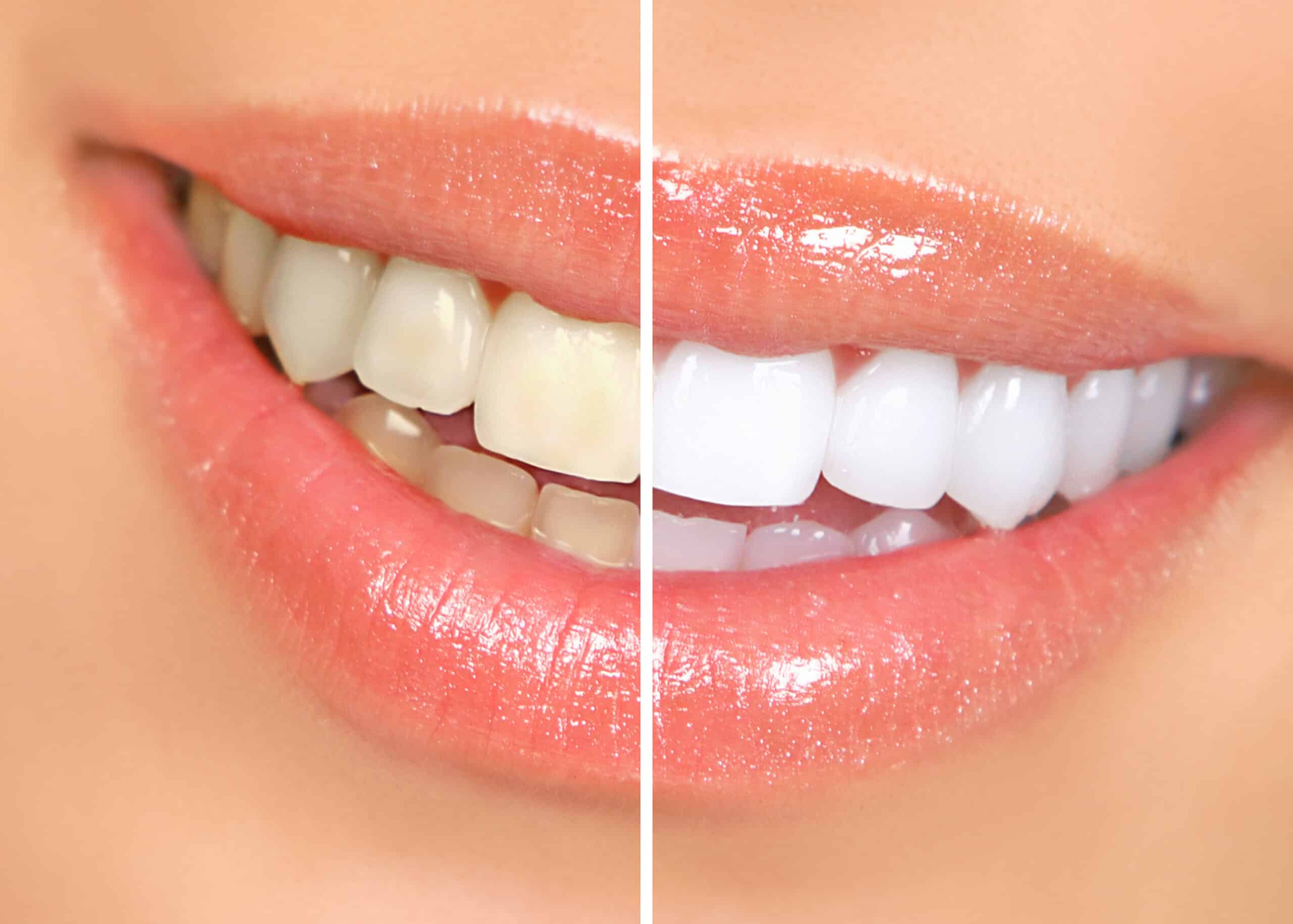 teeth.whitening scaled