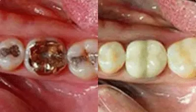 Before and after