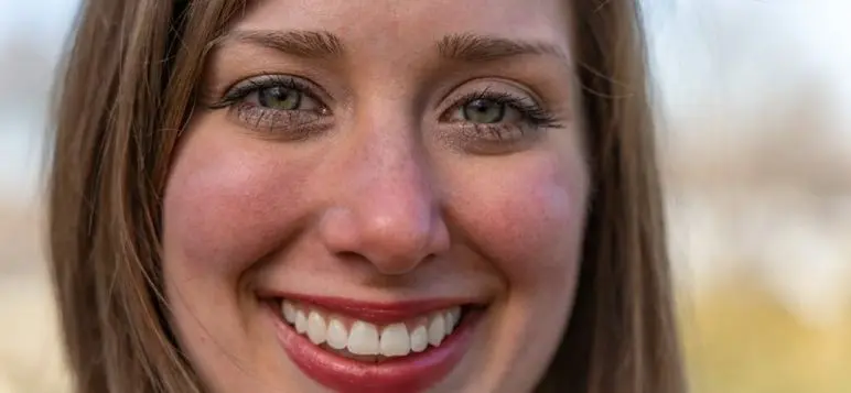 dental veneers alternative to orthodontics image