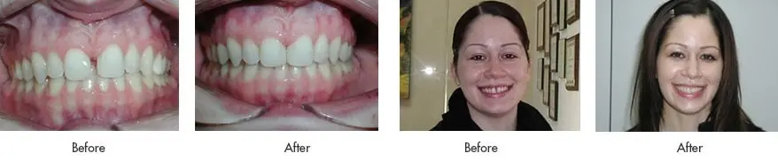 before after invisalign 1