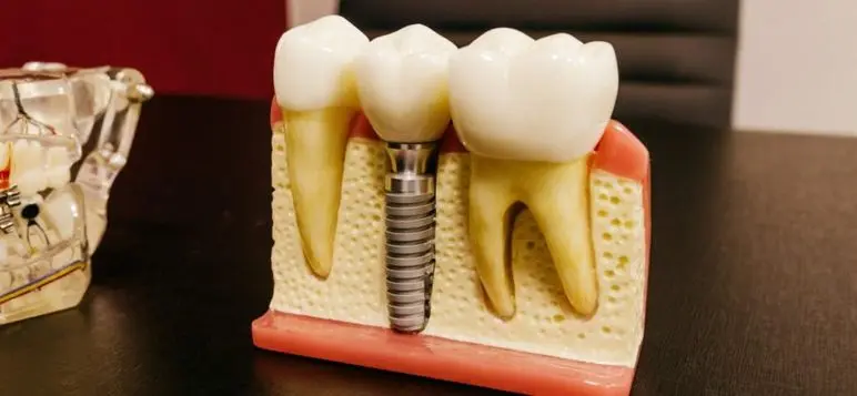 Dental implants An affordable image