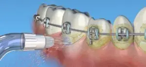 Are Water Picks Good For Your Teeth?