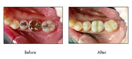 before after main modal