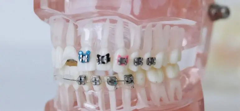 invisalign compare to braces image