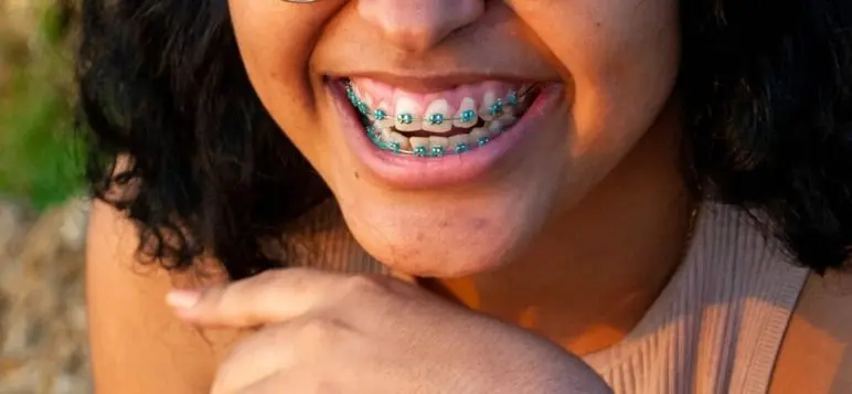 before and after braces image