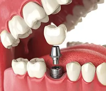 fix your missing teeth with dental implants chicago il 1