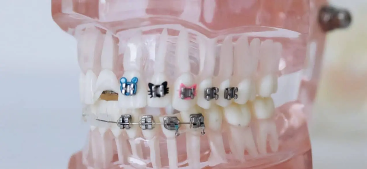 invisalign compare to braces image