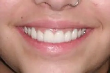an image of a woman with piercing smiling after her procedure in big smile dental