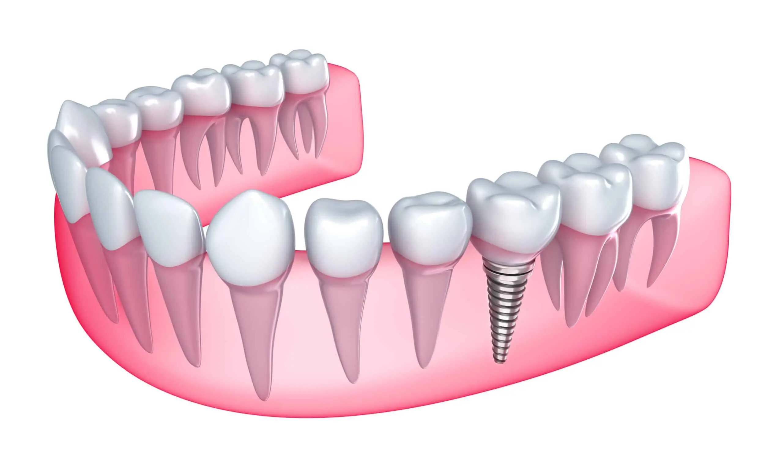 teeth.implant 1 scaled