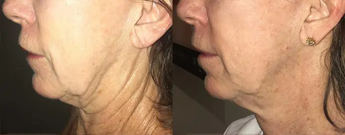 RF Microneedling
