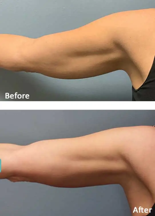 Evolve Fat Loss & Skin Tightening