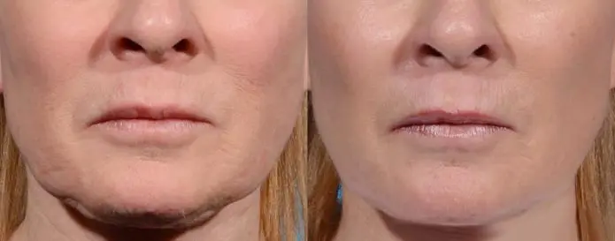 RF Microneedling