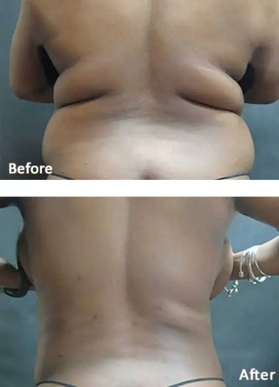 volve Fat Loss & Skin Tightening