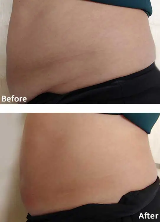 volve Fat Loss & Skin Tightening