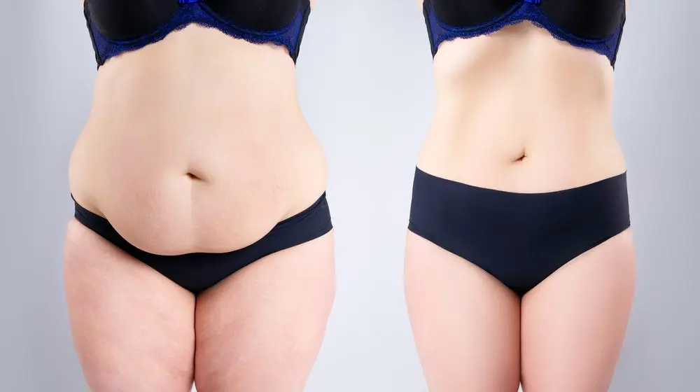 Liposuction