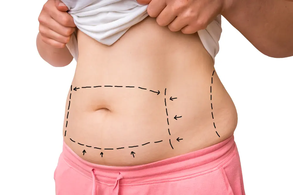 Liposuction in Brookings, OR 