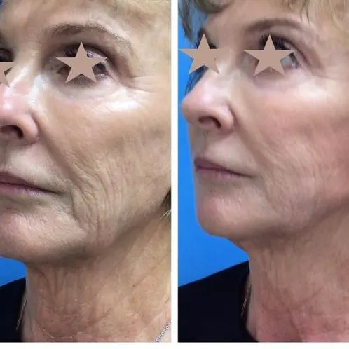 4 months post Ultherapy 4 months post Ultherapy