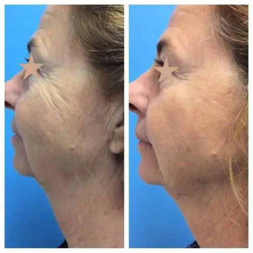 1 tx Ultherapy 6 months post 1 tx Ultherapy 6 months post