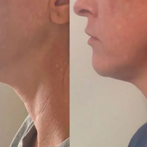 Ultherapy 2 months post Ultherapy 2 months post