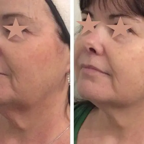 3 monhts post 1 Ultherapy and 1 Profound Matrix 3 monhts post 1 Ultherapy and 1 Profound Matrix