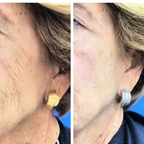 3 months poast 1 ultherapy face 3 months poast 1 ultherapy face