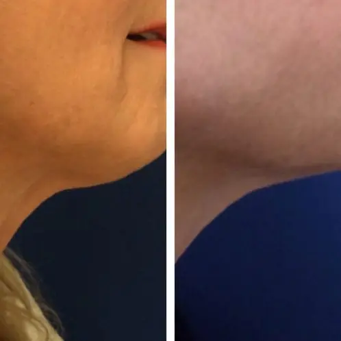 2 tx Post Ultherapy Neck 2 years post 2 tx Post Ultherapy Neck 2 years post