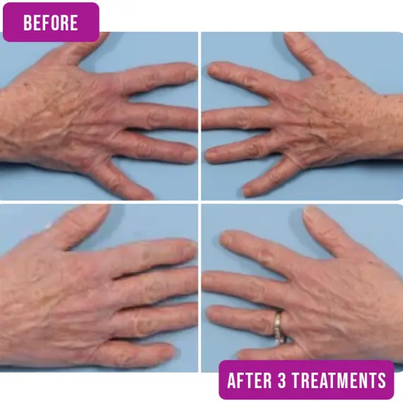 Nordlys before after hands Nordlys before after hands