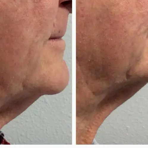 3 months post 1 Ultherapy Neck and Jawline 3 months post 1 Ultherapy Neck and Jawline