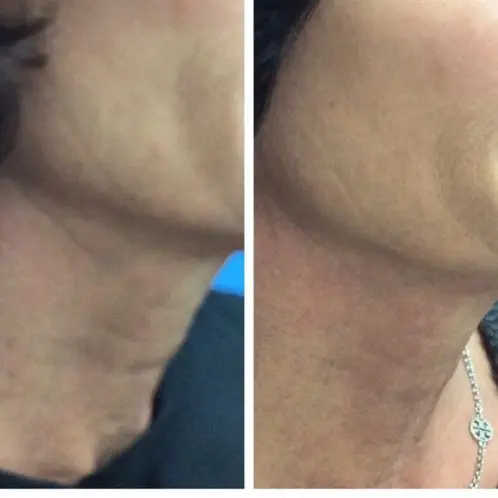 1 Ultherapy tx Jawline and neck 1 Ultherapy tx Jawline and neck