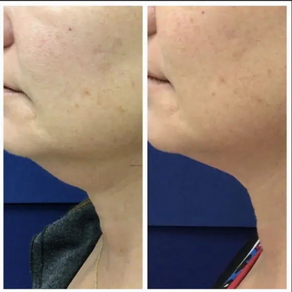 ultherapy before after 2 ultherapy before after 2