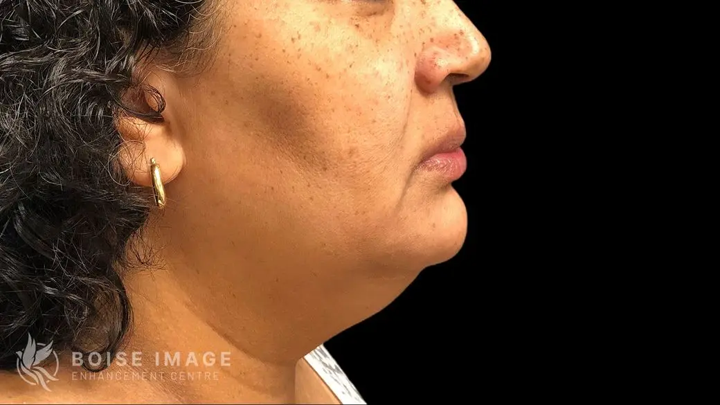 Kybella After