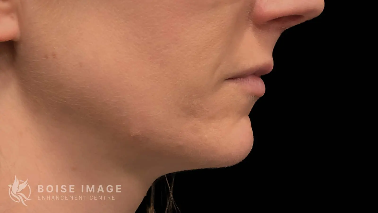 Lips After