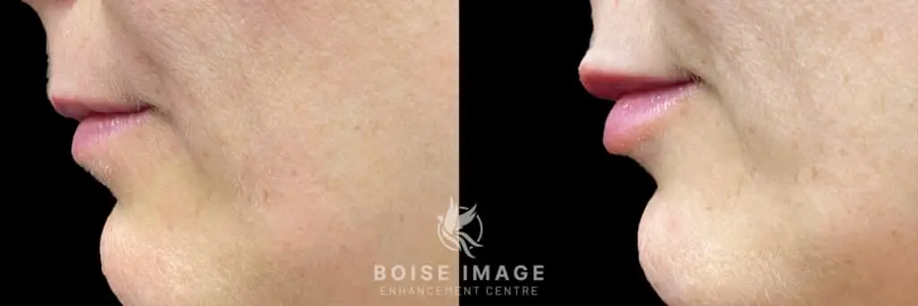 Restylane Silk Lip Filler Before and After 2 Side Profile