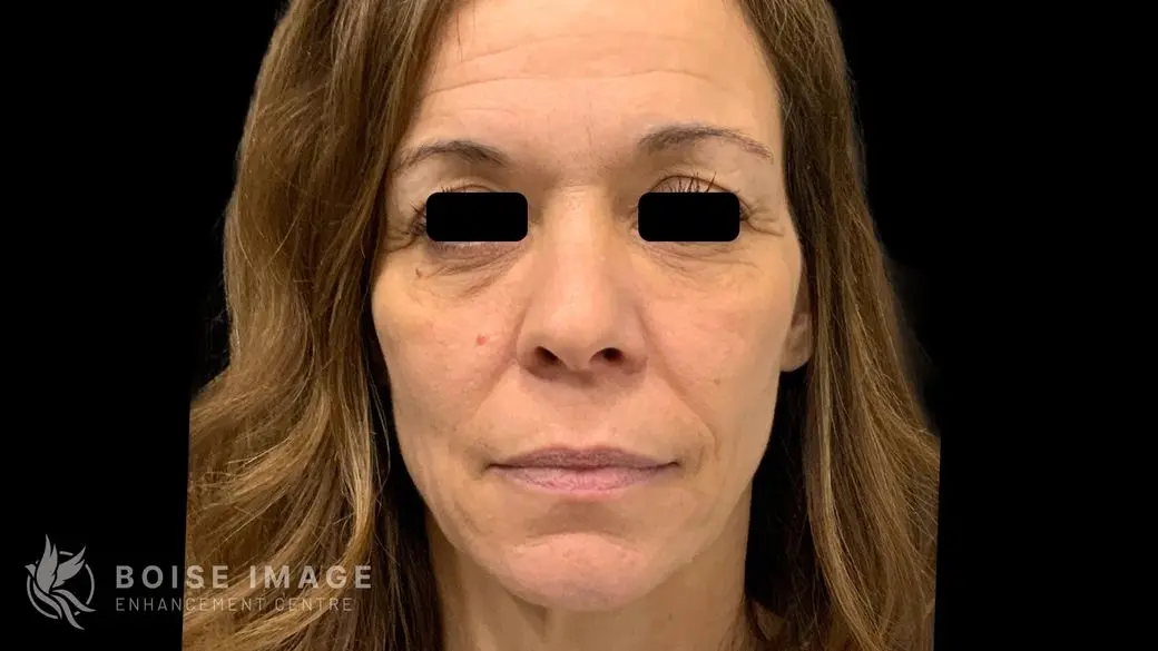 Full Face After