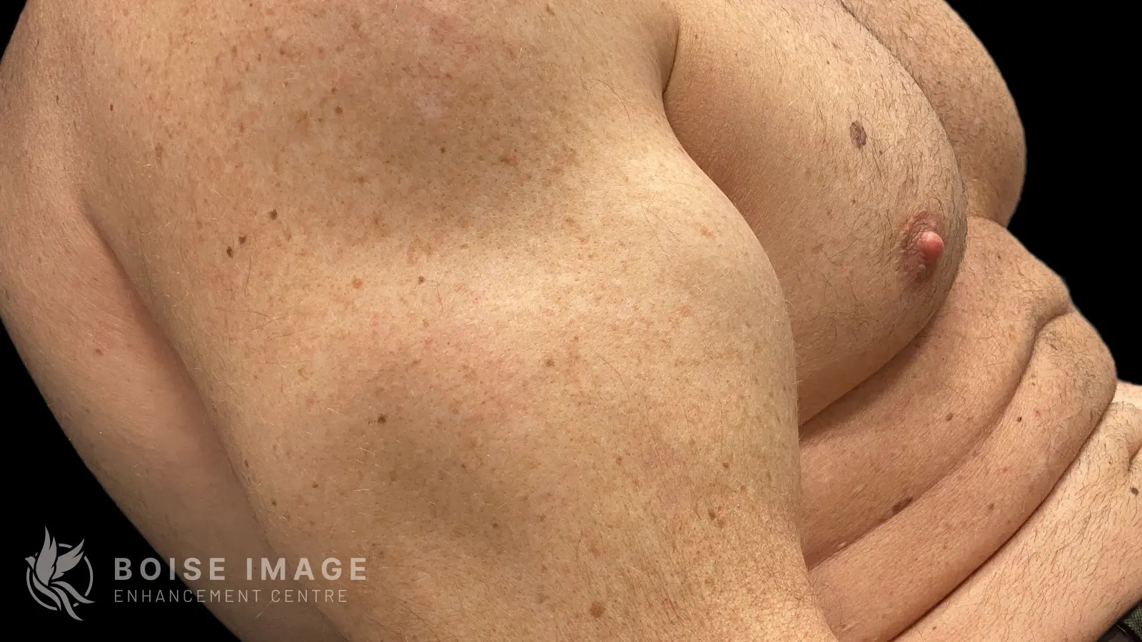 Left Bicep After