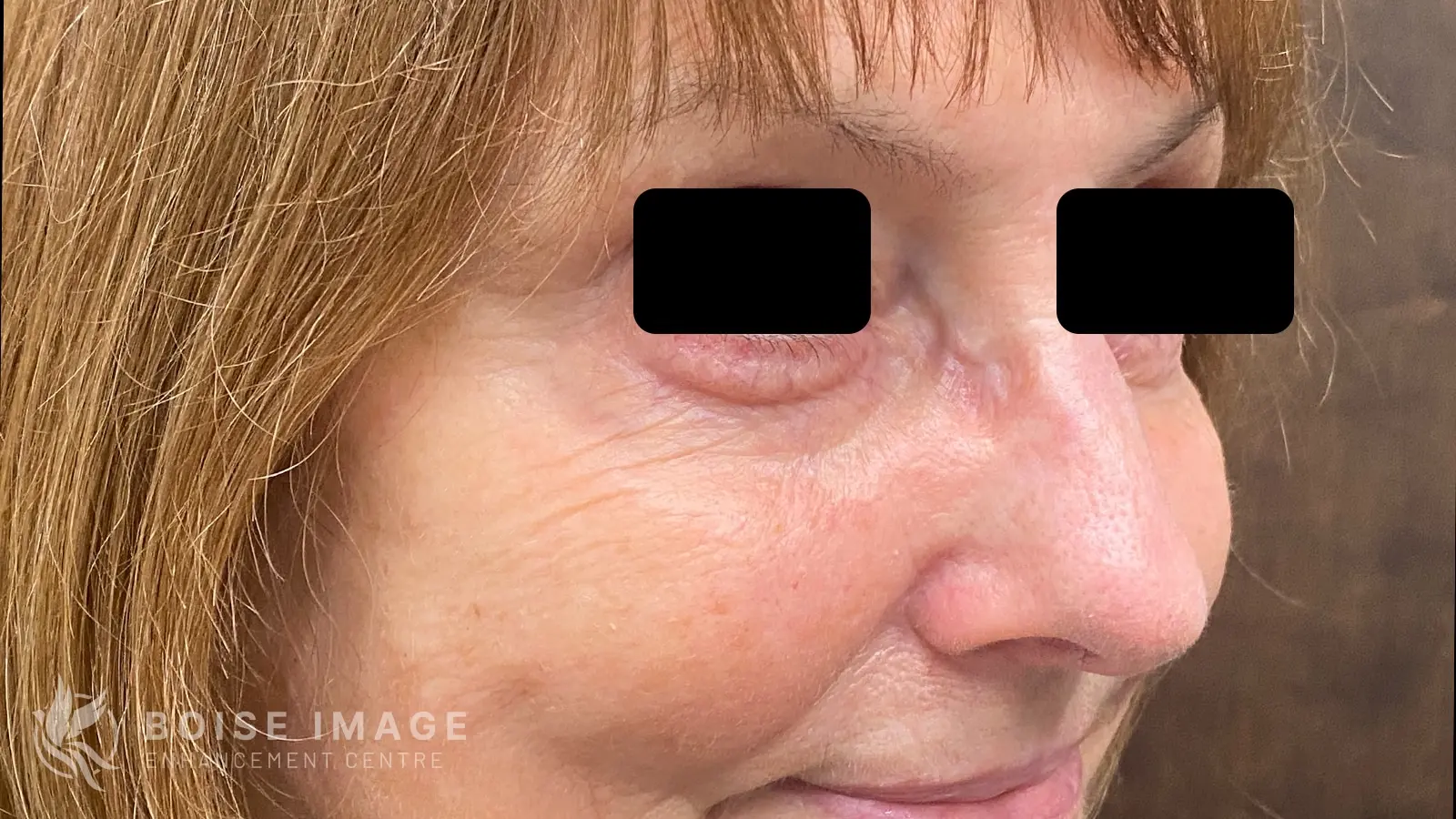 Under Eyes Before