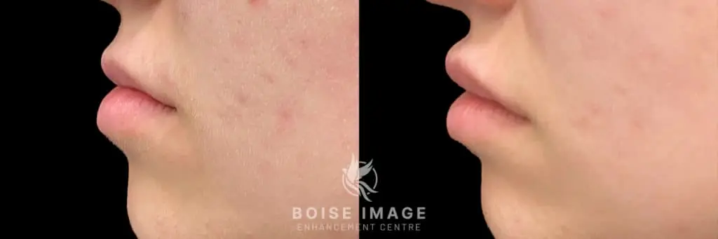 Restylane Silk Lip Filler Before and After Side Profile
