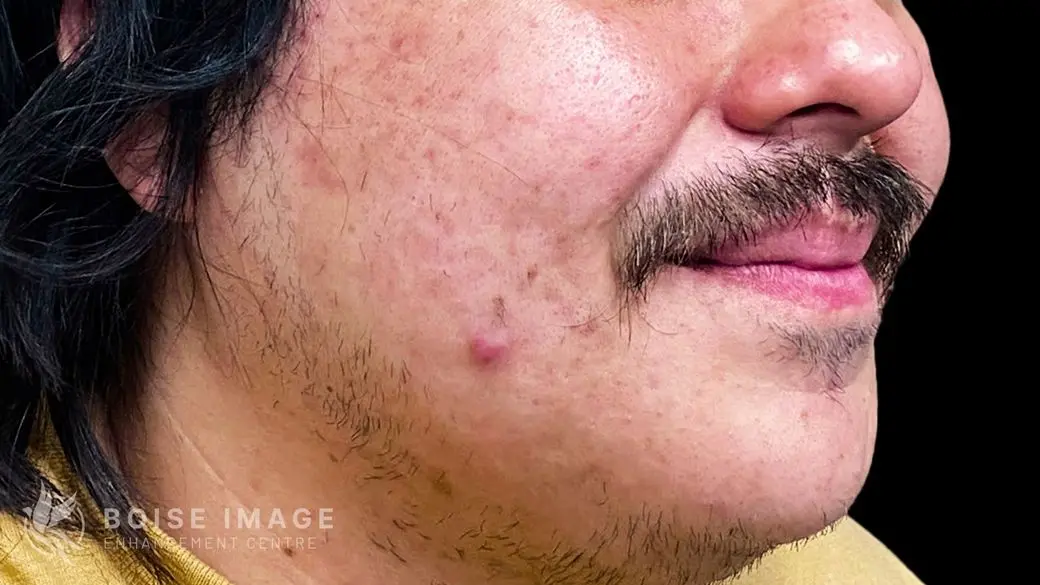 Cheeks After