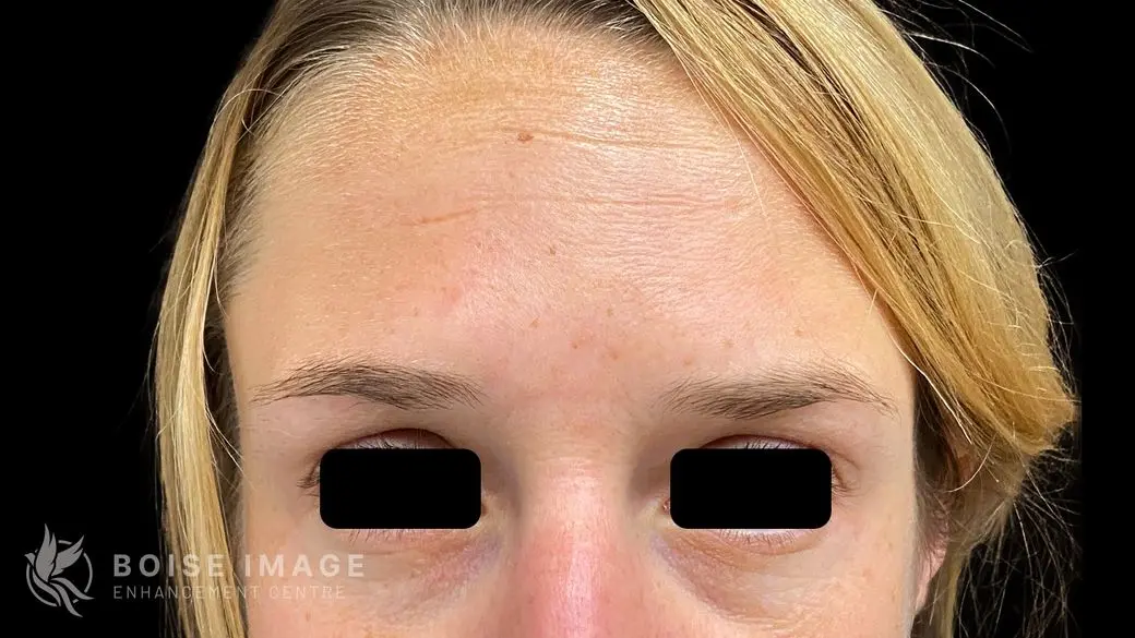 Forehead After