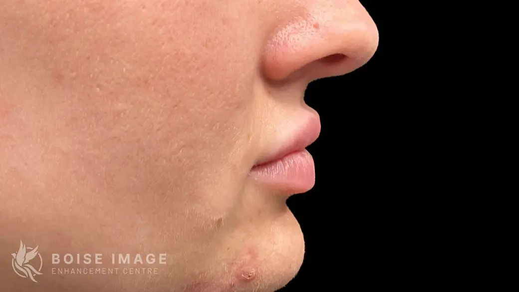 Lips After