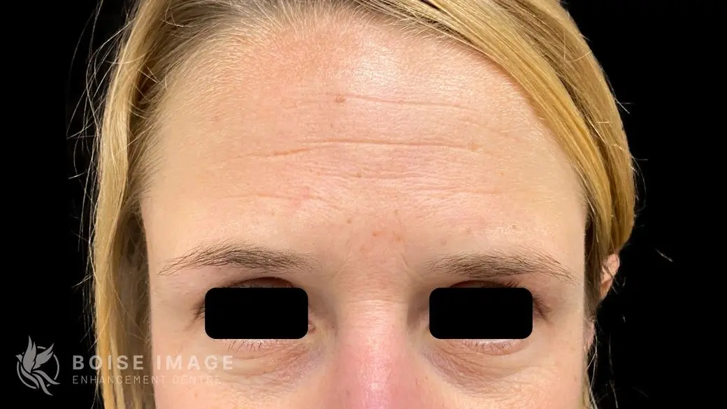 Forehead Before