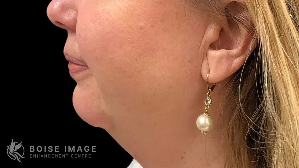 Kybella After